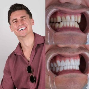 veneers