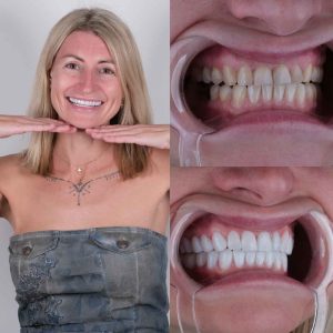 veneers-before-after