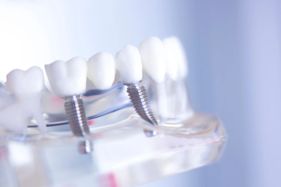 Diş implantı