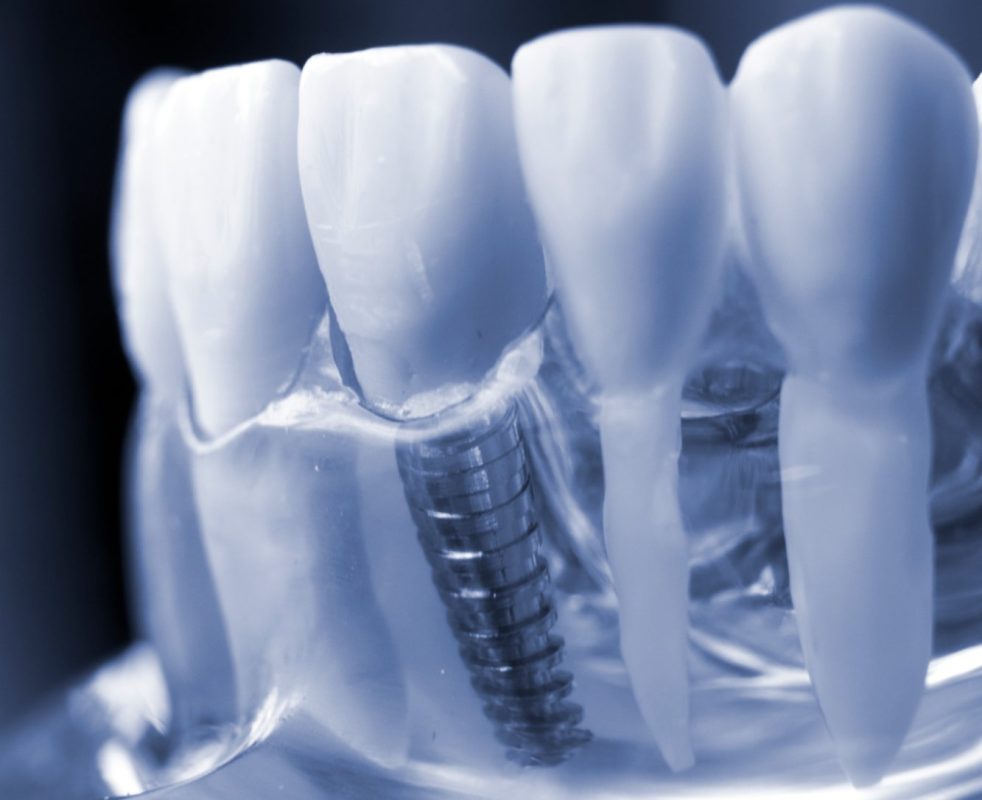 Diş implant Nedir?