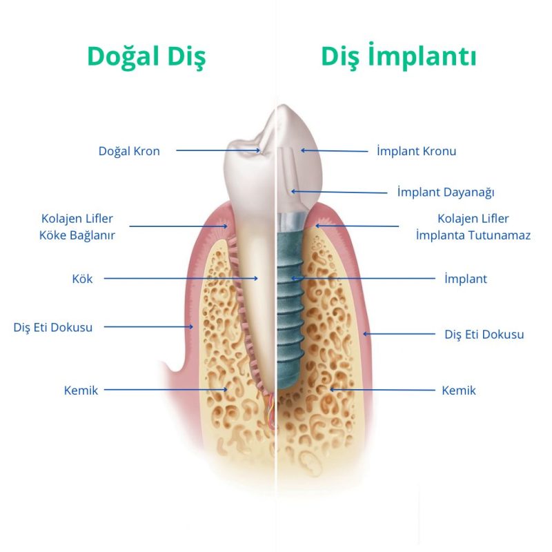 sıfır implant yeri