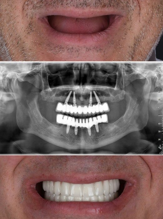 All-on-Four implant tekniği nedir