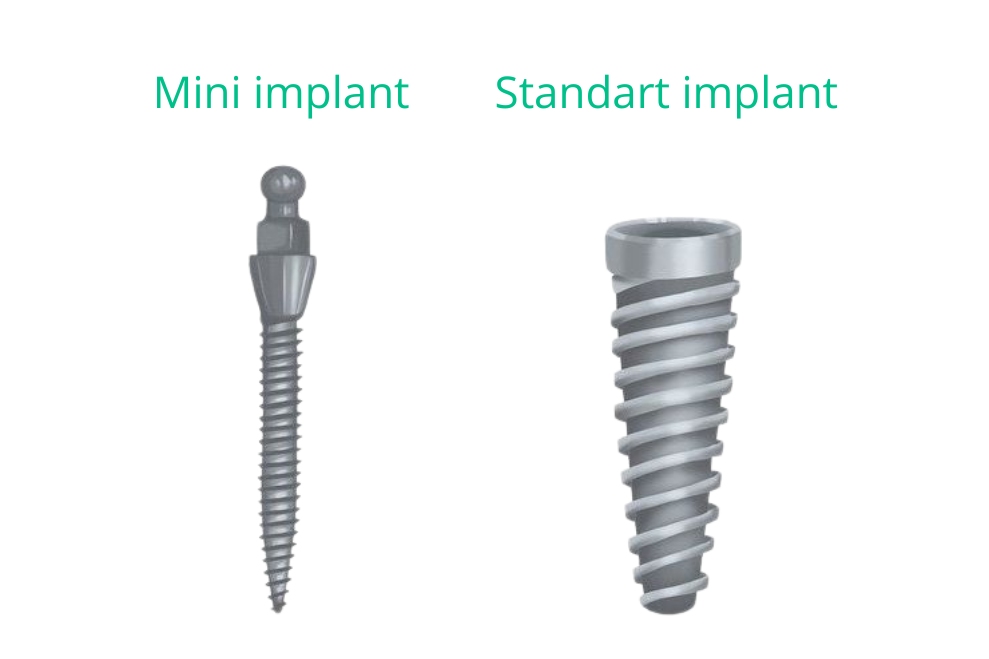 Standart diş implantları ile mini implantların boyut ve şekil açısından karşılaştırması