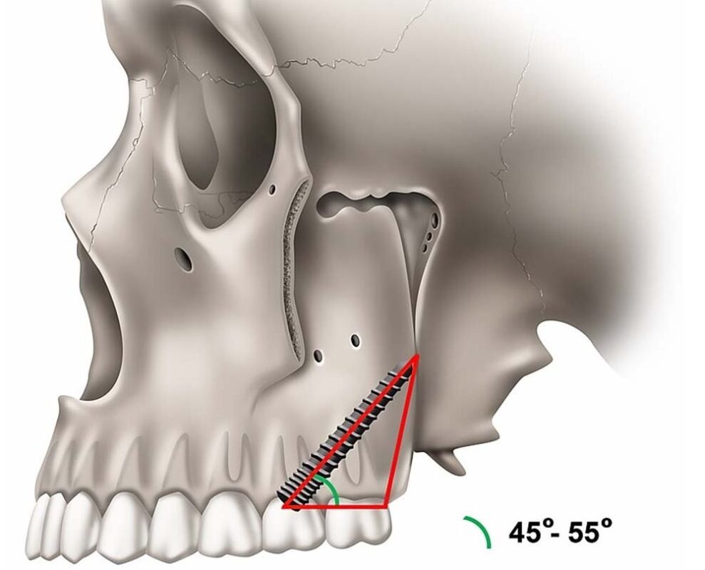 Pterygoid İmplantların yerleştirilmesinin şematik gösterimi