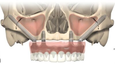 Scheme of Zygomatic Implants