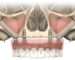 Scheme of Zygomatic Implants