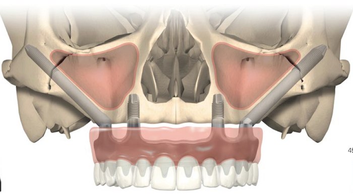 Scheme of Zygomatic Implants