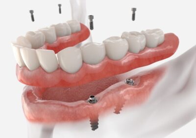 Diş implantı uygulaması – kalıcı ve sağlıklı diş çözümü