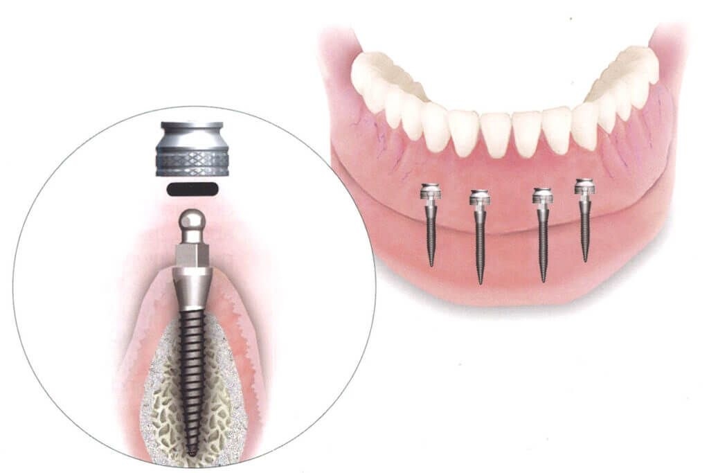 Dişlerin yenilenmesi için modern çözüm: mini implant